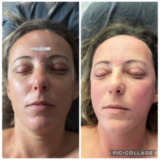 Home 17 Blepharoplasty Cosmetic Post Op Recovery