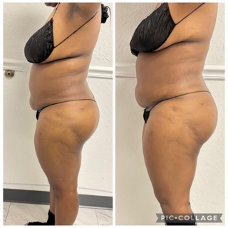 Lymphatic Drainage