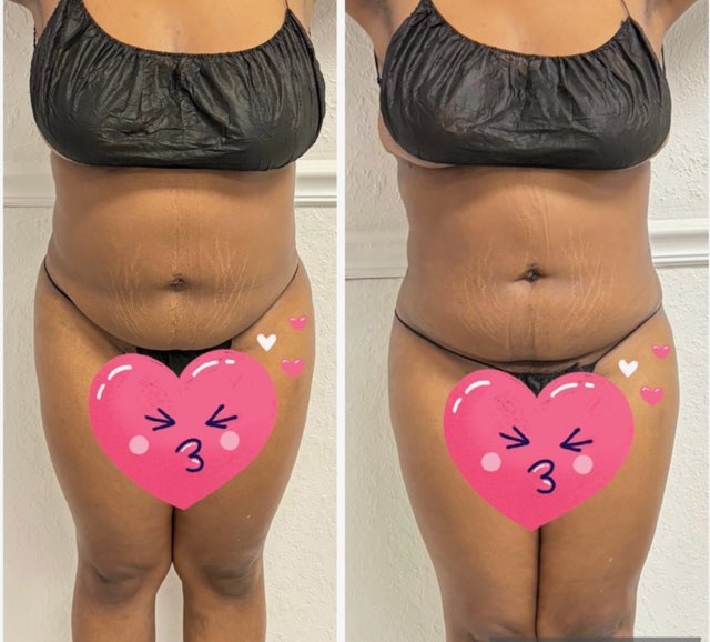 Body Sculpting