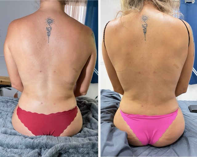 Lymphatic Drainage
