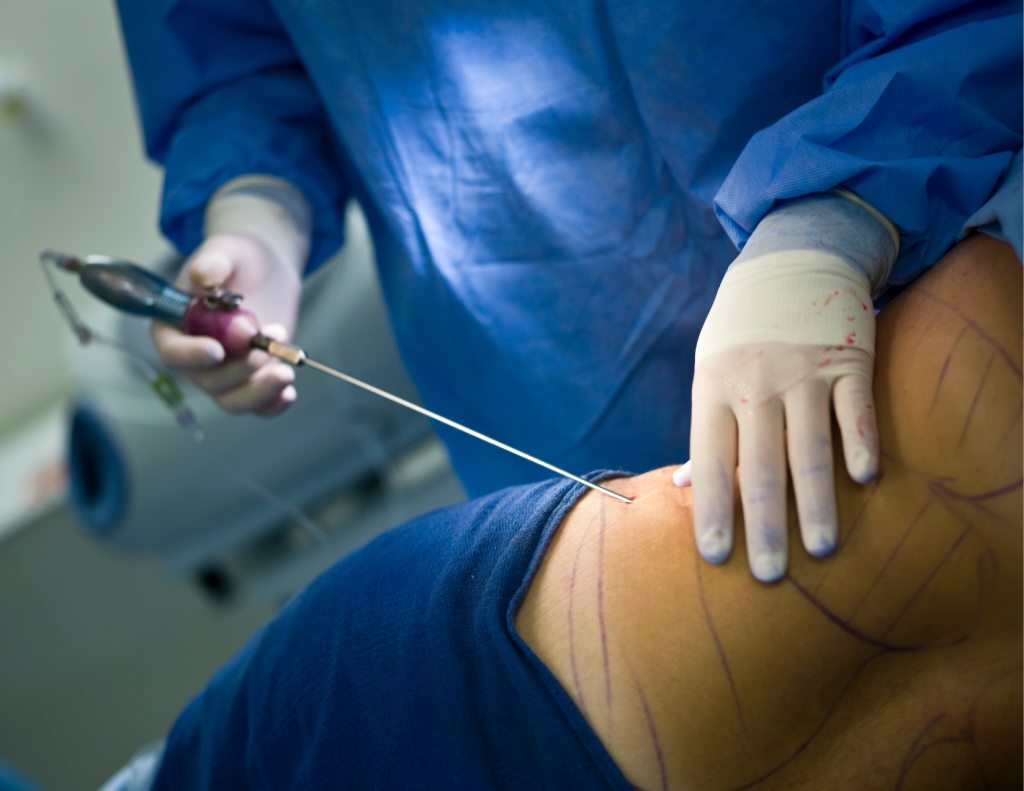 Home 9 liposuction