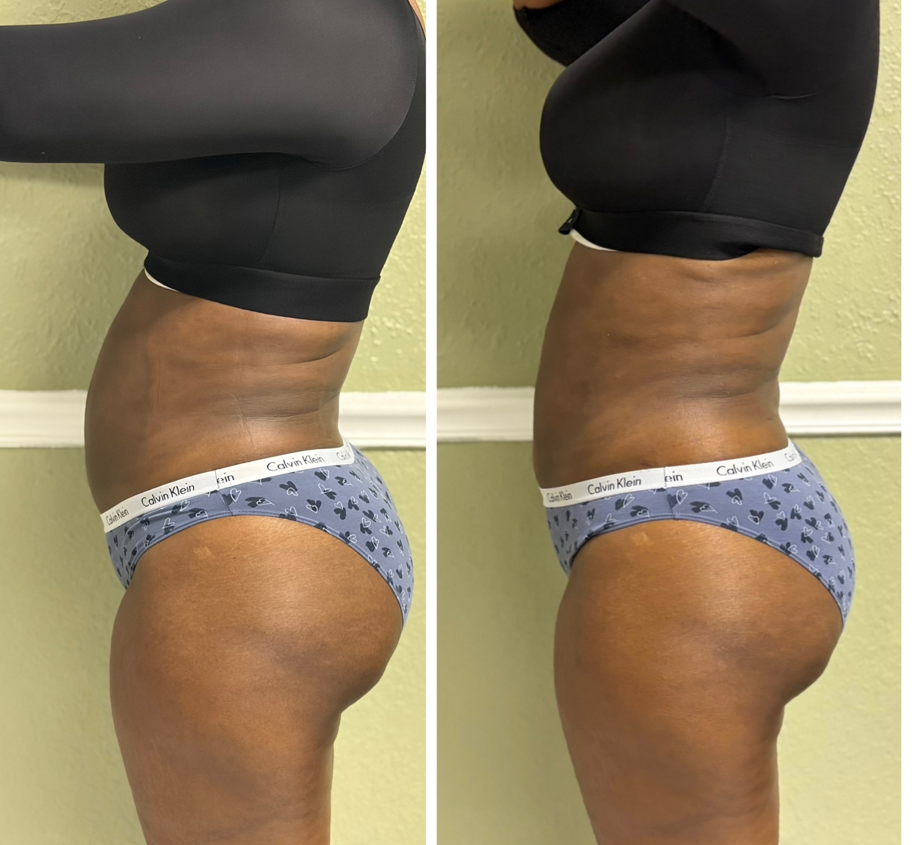 Lymphatic drainage 1 session at Glam Therapy by Crystal Mack